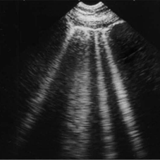 B Lines | Point Of Care Ultrasound